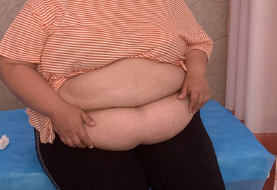 51岁肖华在康达减肥7个月瘦112斤1