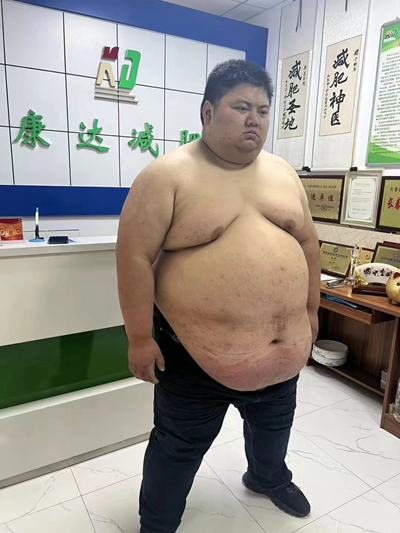 安徽吴超康达减肥十三个月瘦263斤1